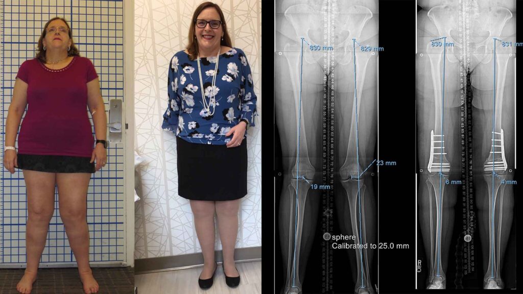 Knock-knee-patient before and after