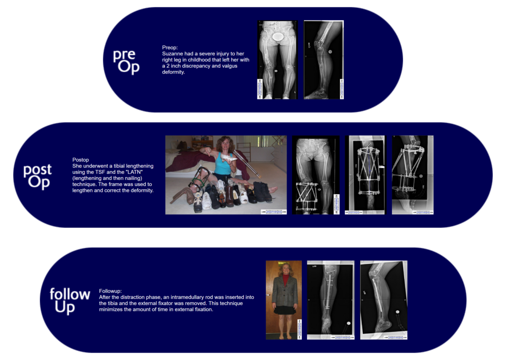 Suzanne - limb lengthening patient